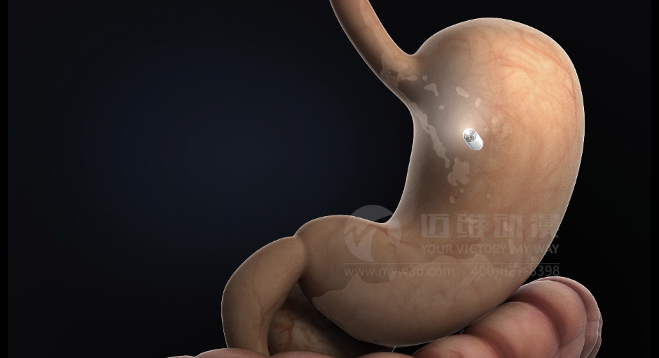 醫(yī)學(xué)醫(yī)療三維動(dòng)畫(huà)