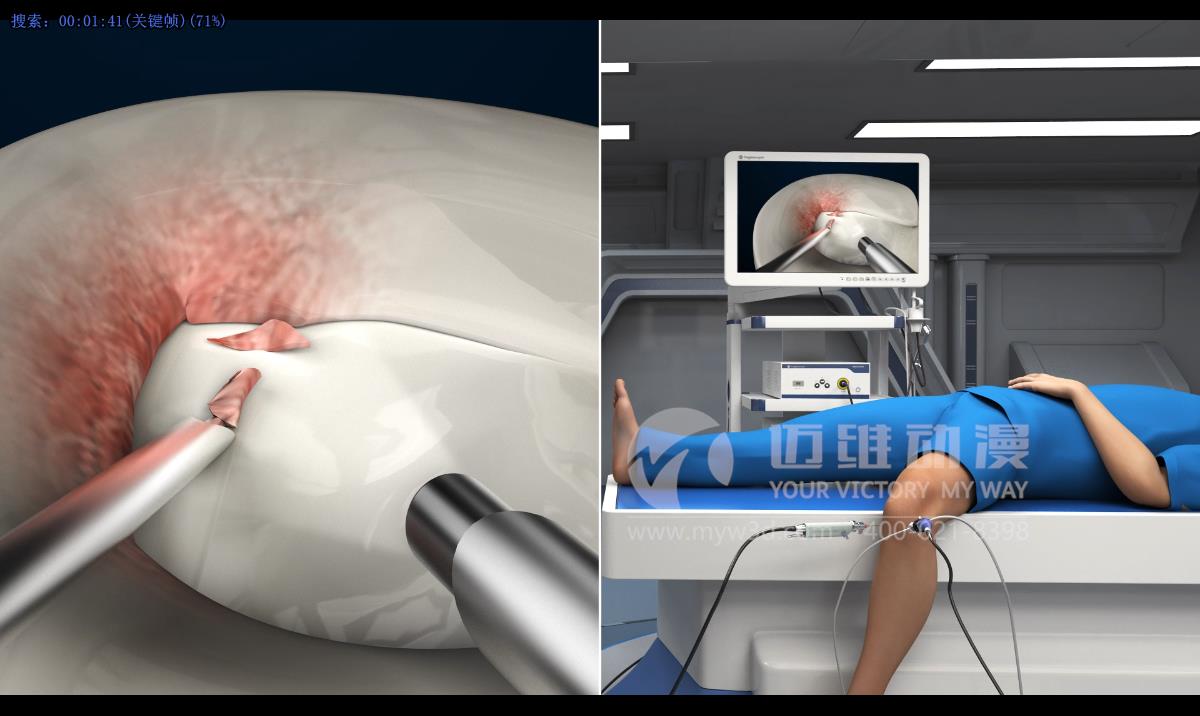 人體手術(shù)三維動畫.jpg 人體手術(shù)三維動畫.jpg