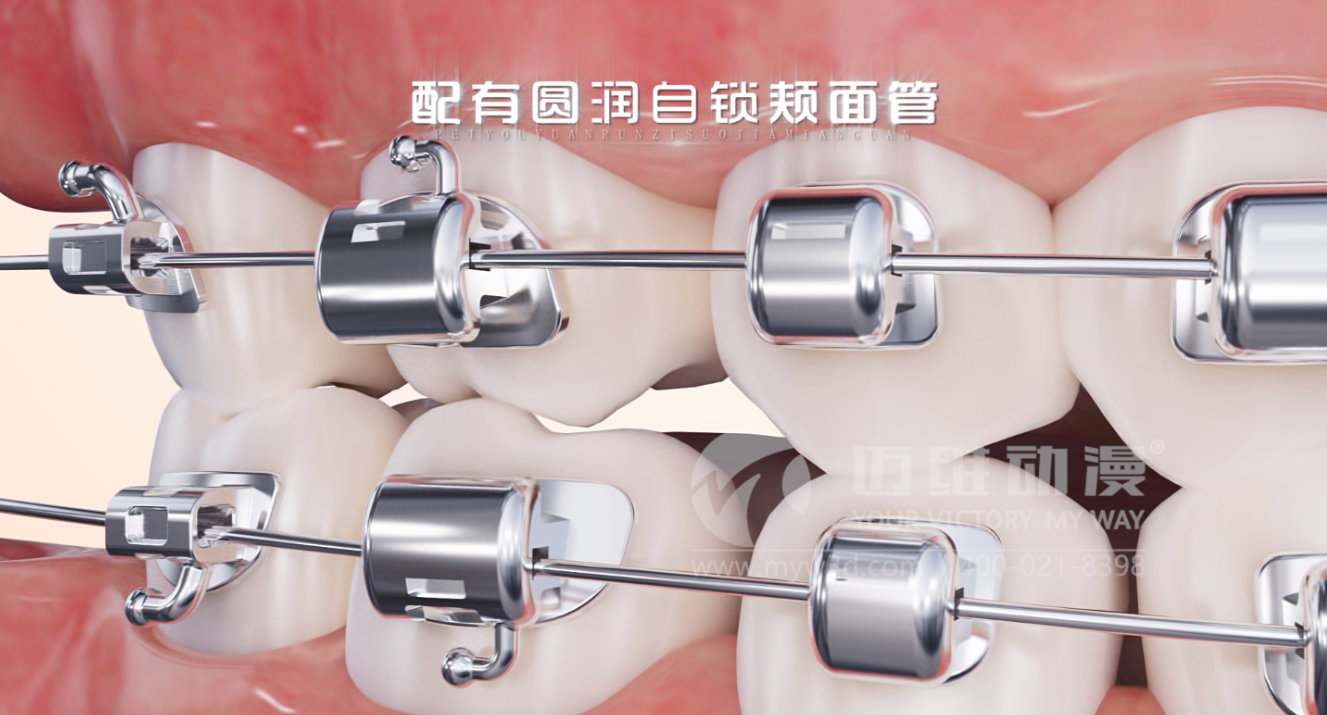 華文7D自鎖托槽產(chǎn)品展示三維動(dòng)畫(huà)(圖1)